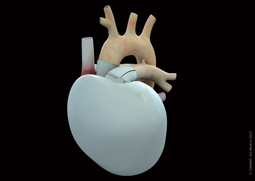 Carmat artificial heart