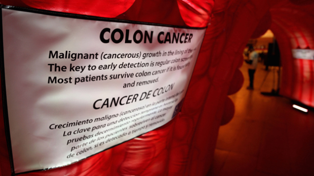 colon cancer