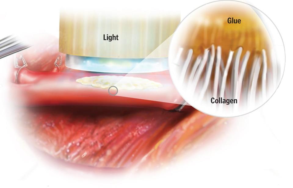 Is Gecko's Bio-inspired Glue going to revolutionize Heart Surgery and  Tissue Repair? 