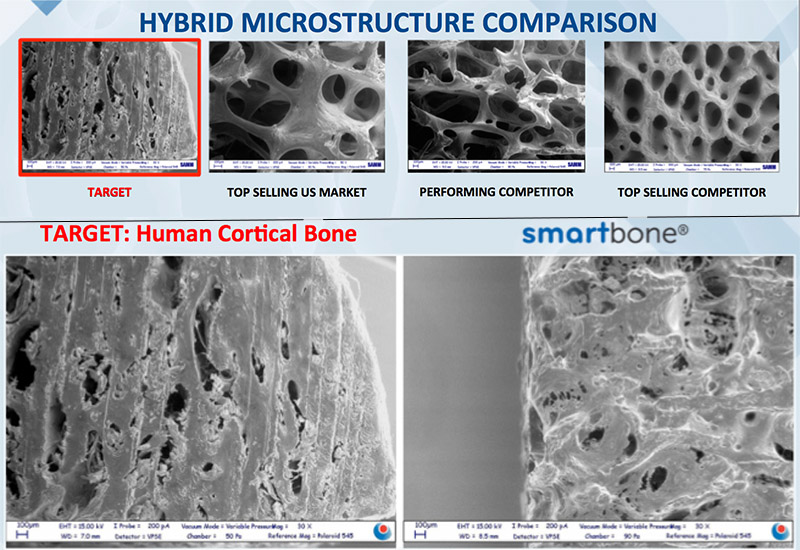 bone graft