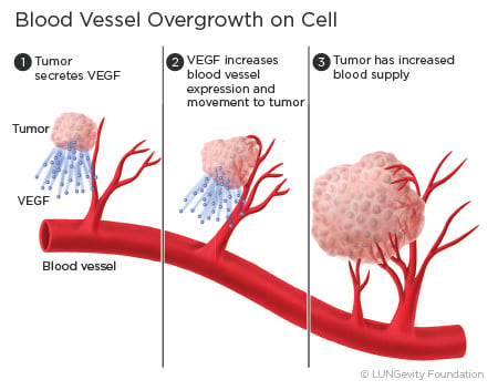 Angiogenesis is blocked by Bevacizumab (Source: Lungevity Foundation)