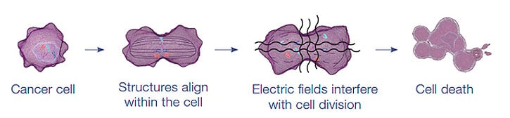 Alternating electric field therapy uses low frequency electrical fields to disrupt solid tumor cell division (Source: NovoCure)