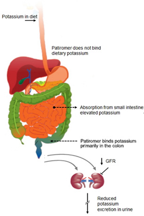 Mechanism of how Patiromer works - Relypsa's oral suspension for hyperkalemia. (Source: Relypsa)