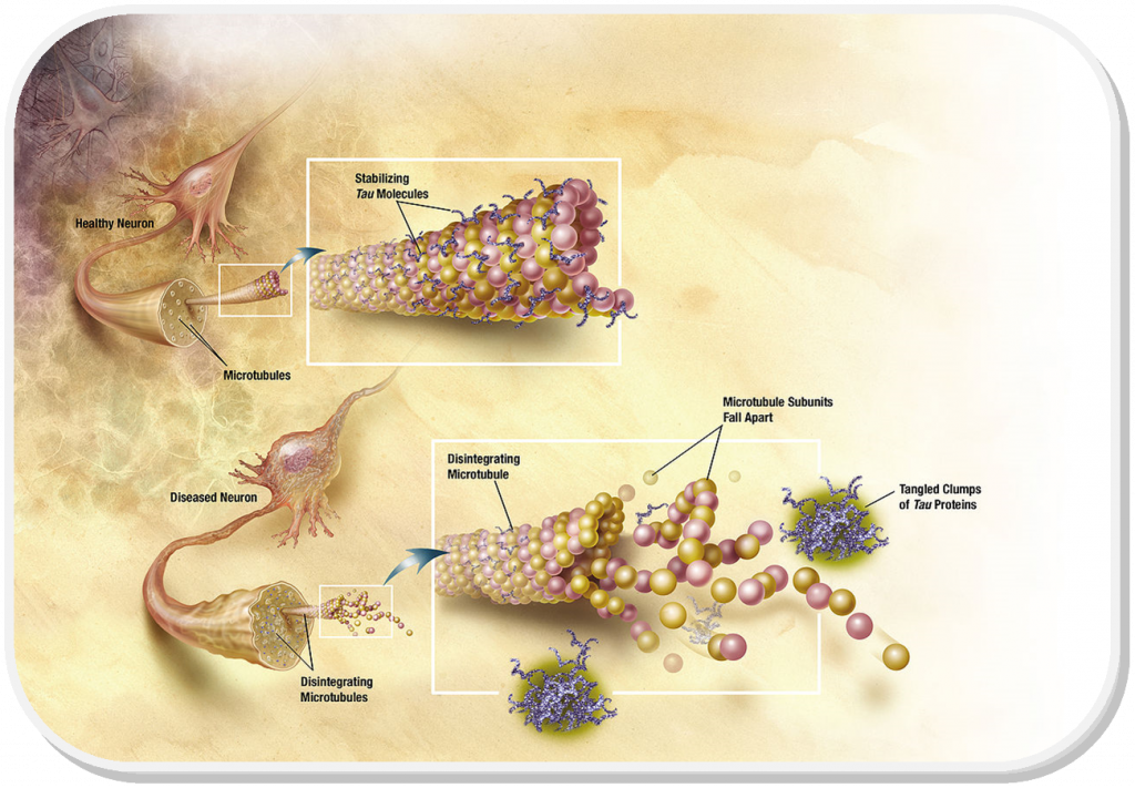 Hyperphosphorylation of the Tau protein causes neuronal damage in Alzheimer's Disease