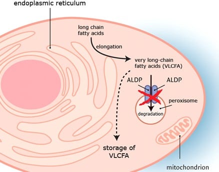 Mutation of the ABCD1 Gene causes a dysfuncitonal protein in the peroxisome (ADLP) to stop break down of long amino acid chains, which cause extensive tissue damage (CC: Engelen & Kemp at X-ALD NL)