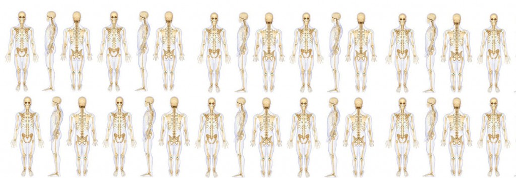 Achondroplasia