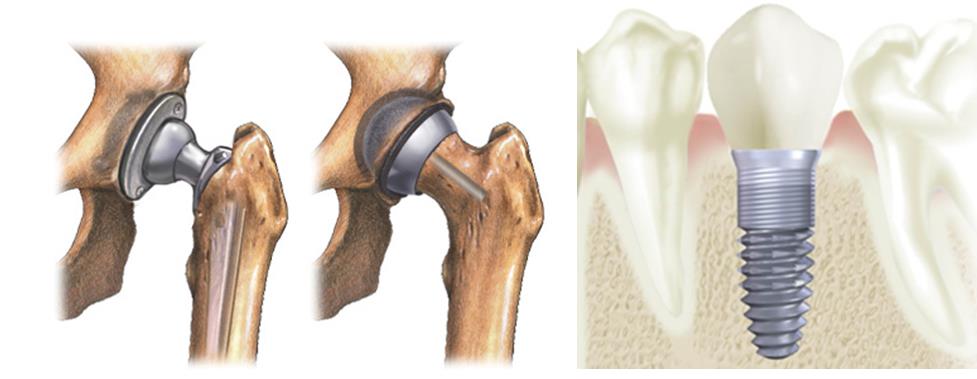 Examples of titanium implants include hip replacements and dental roots 