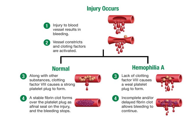 Source: National Hemophilia Foundation 