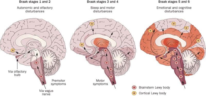 Parkinsons_braak_cns_neurodegenerative