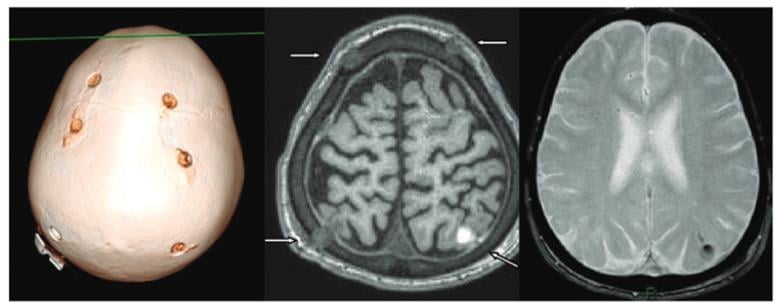 lysogene_aav_gene_therapy_rare_disease_sanfilippo_syndrome