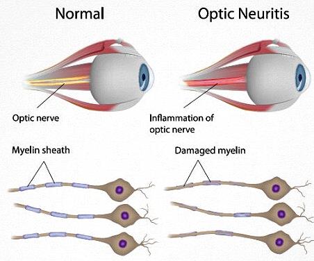 biotechs_Cytotools_ms_optial_neuritis_medday_black_friday_phase_III_failure