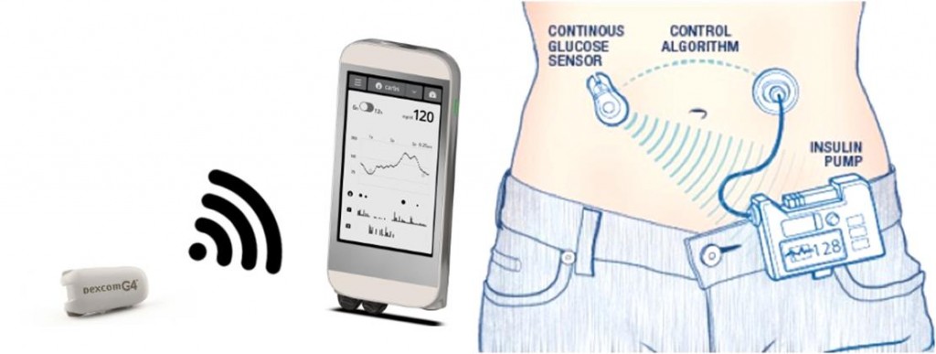 bionic_pancreas_ilet_boston_cyborg_biotech_medtech