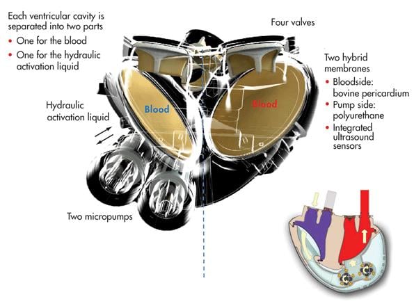 carmat_heart_cyborg_bionic_medtech_biotech