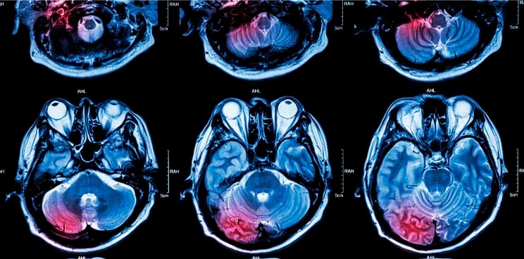 immunocore eye uveal cancer immtac1