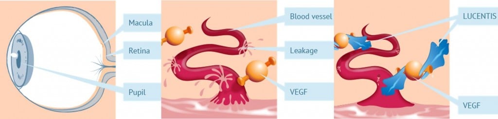 macular degeneration vgef xbrane helvetic primm pharma lucentis xlucane iran biosimilar