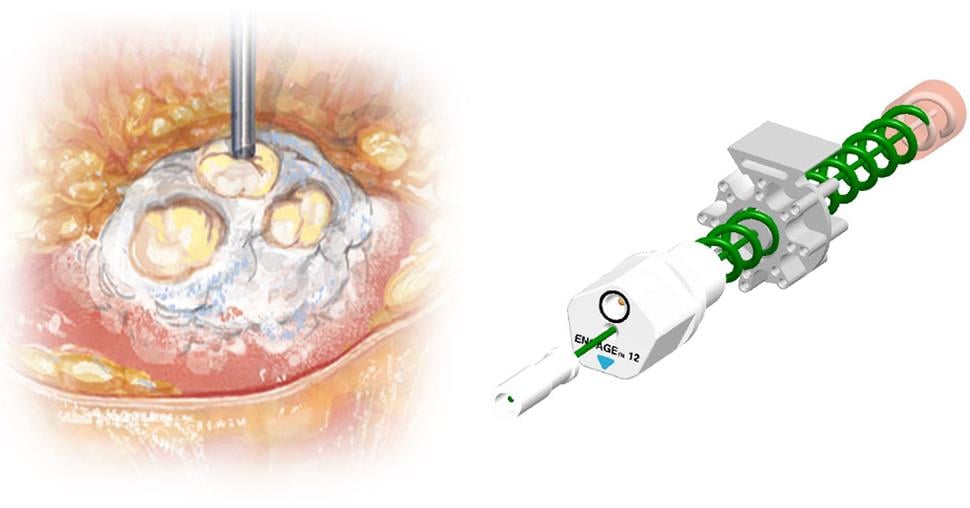 prostate_cancer_ablation_trod_medical_medtech