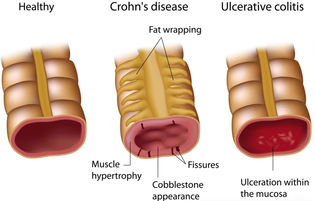 ulcerative_colitis_ibd_crohns_bowel_galapagos_gilead