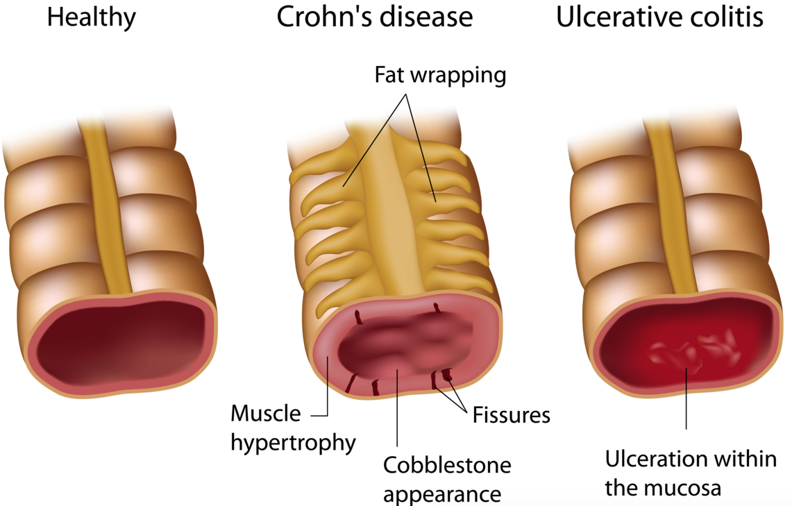 ulcerative colitis abivax HIV