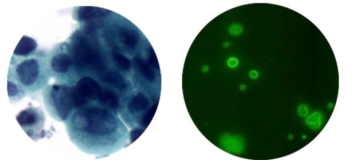 cnrs_ismo_vitadx_bladder_cancer_diagnostics_fluoresence_onera