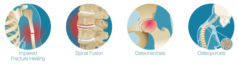 osteoporosis_spinal_fracture_bones_disease_therapeutics_kasios_preob_allob