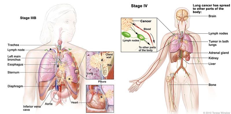 tedopi_nsclc_lung_ose_pharma_cancer_atlante