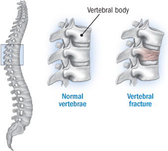 vertebral_fracture_denosumab_osteoprorsis_ucb_amgen