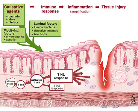 chron's_disease_gastrointestinal_mycobacterium_map_redhill_biopharma_phase_III_rhb-104