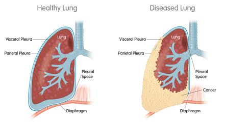 mpm_malignant_pleural_mesothelioma_sellas_wt1_vaccine_cancer_fda_orphan_drug