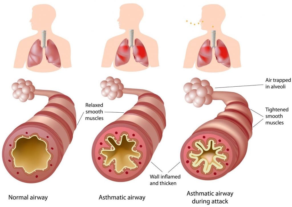 severe_asthma_tevas_reslizumab_cinqair