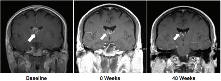 ariad_brigotinib_nsclc_brain_metastases