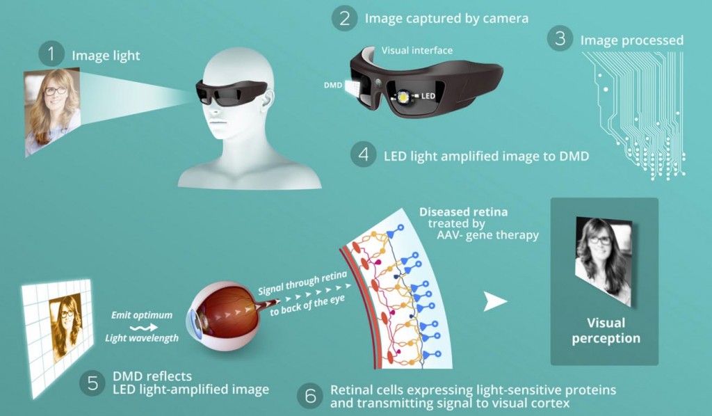 biomimetic_goggles_biotech_GenSight_vision_blindness_LHON_retina_opthalmology_prostheses_medtech