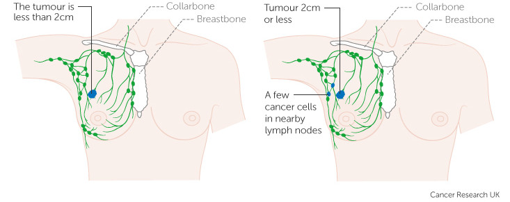 breast_cancer_lymph_nodes_chemotherapy_mammaprint