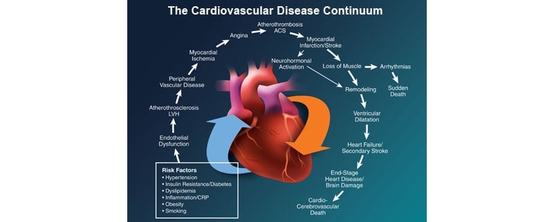 cardiovascular_disease_lipigon_astrazeneca