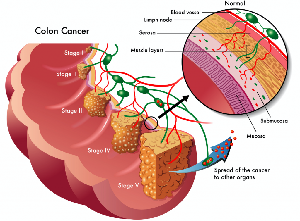 colorectal_cancer_epigenomics_epiprocolon_stages_colon