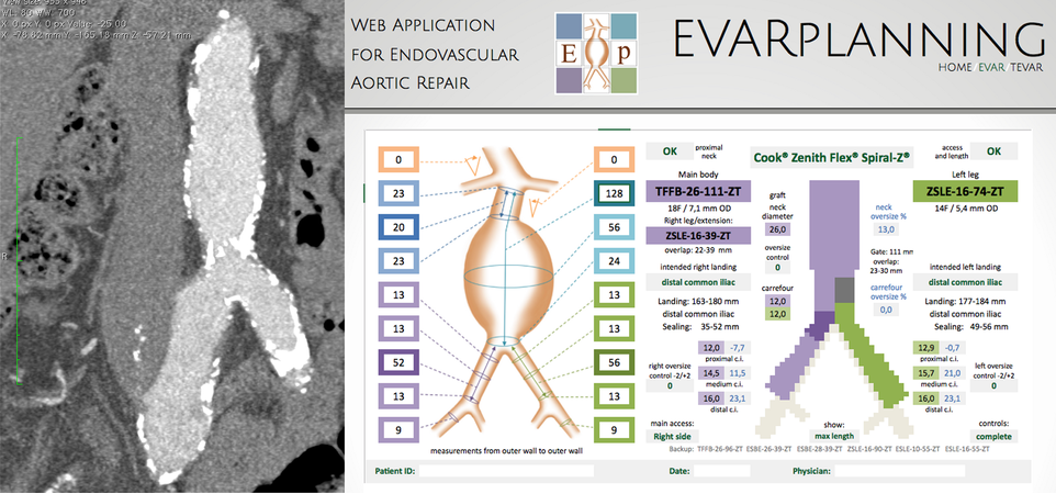 endovascular_aortic_replair_evar_planning_startup_italy_bioupper_accelerator