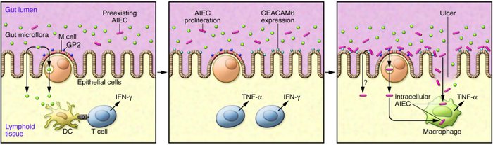 enterome_aiec_coli_ibd_bowel_crohns