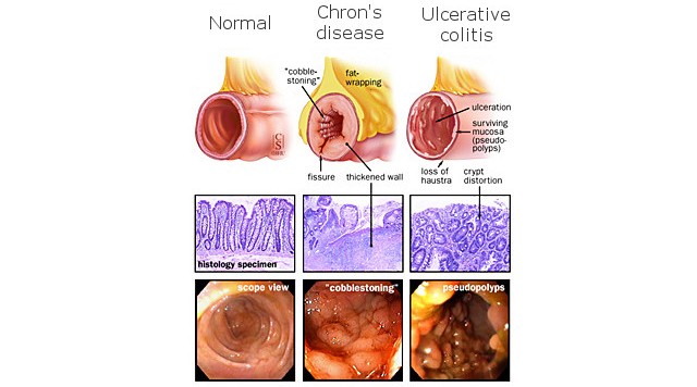 enterome_inflammatory_bowel_ibd_chron's