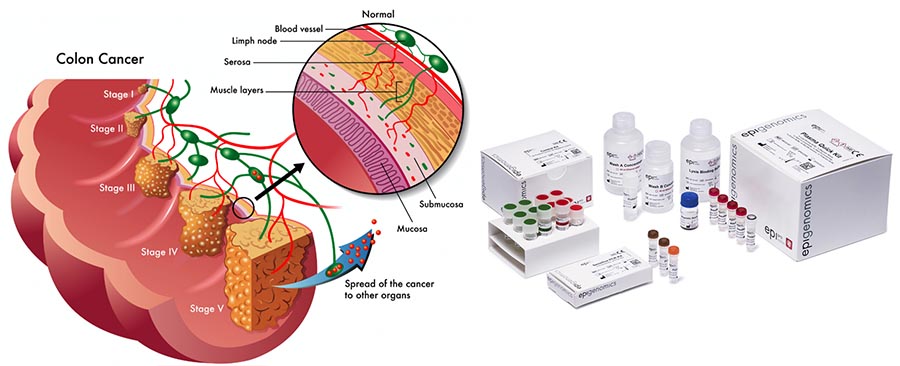 epigenomics_colon_colorectal_cancer_epigenomics_septin9_epiprocolon_diagnostic