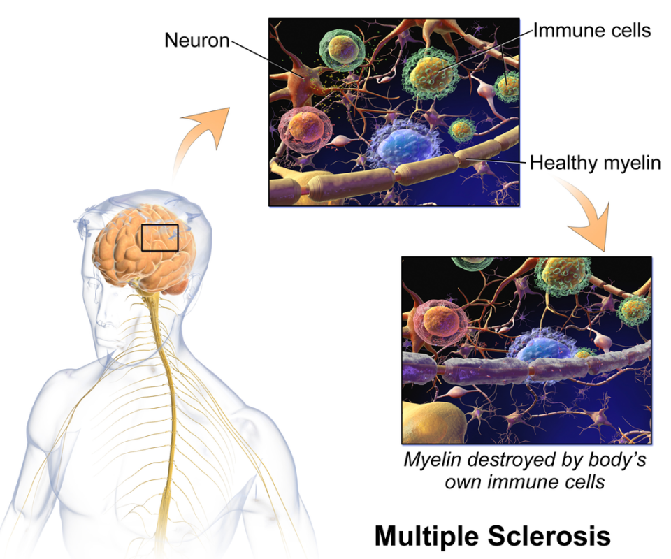 multiple_sclerosis_biotin_medday