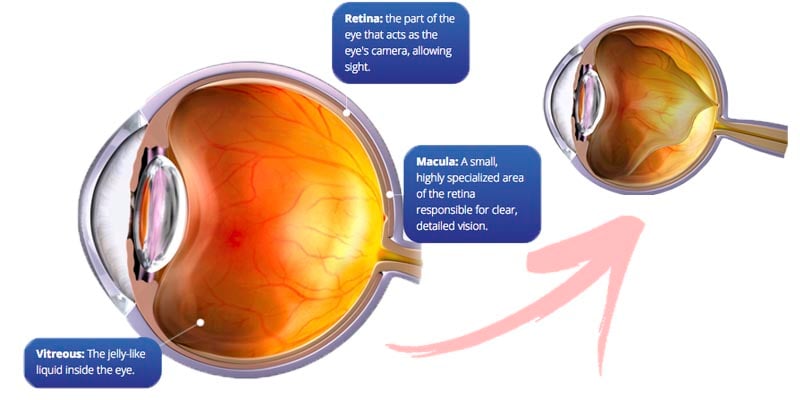 vma_macular_retina_vitreous_thrombogenics_jetrea_biotech