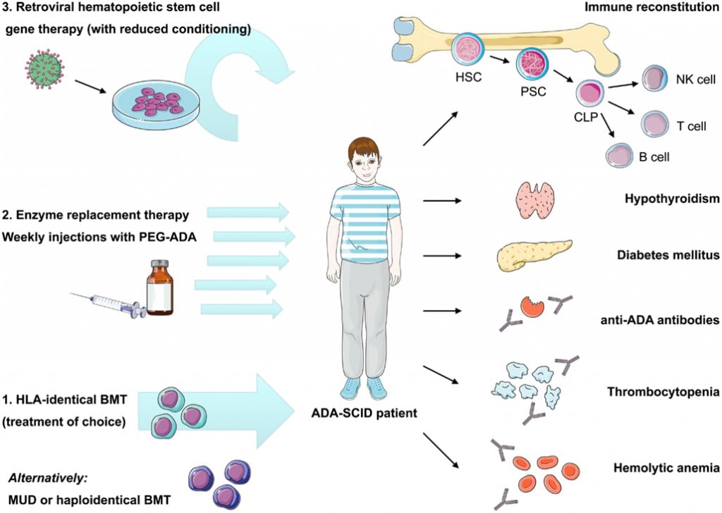 ada-scid_immunology_stremvelis_gsk_offerele_telethon_ema_gene-therapy