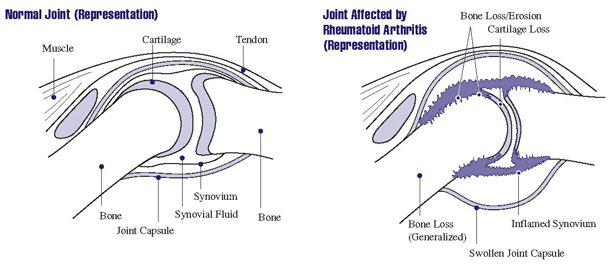 arthritis_disability_inflammation_autoimmune_innventis