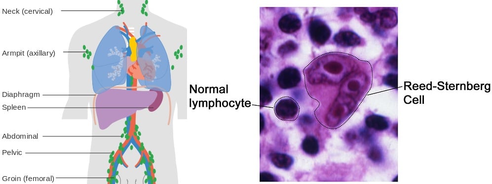 blood_cancer_day_lymphoma_hodgkin's