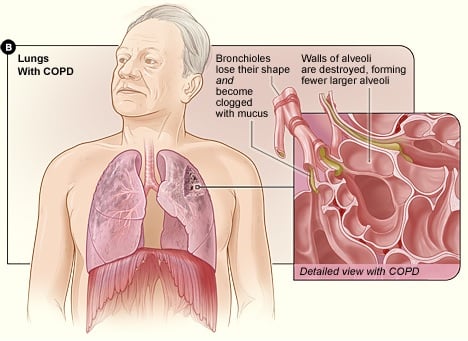 copd_lung_fibrosis_inflammation_ds_biopharma