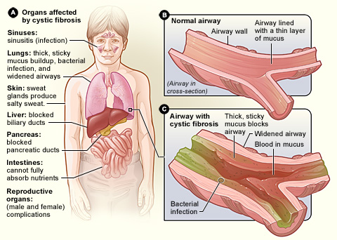 cystic_fibrosis_triple_therapy_galapagos