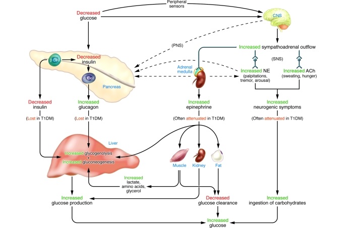 diabetes_type_1_hypoglycemia_unawareness_islet_transplant