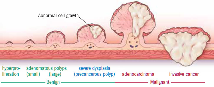 novigenix_colorectal_cancer_polyp_lesions_immune_response_biomarker_tumor