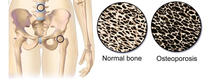 osteoporosis_severe_bone_cell_therapy