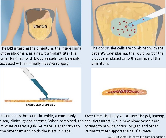 biohub_islet_gel_omentum_type1_diabetes