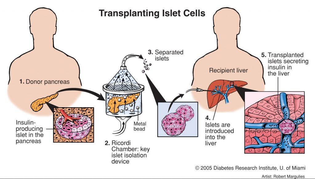 islet_cell_transplant_type1_diabetes_research